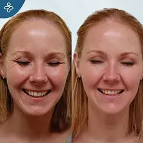 Forehead Lift Before and After Surgery