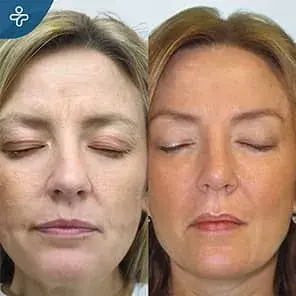 Forehead and facial transformation