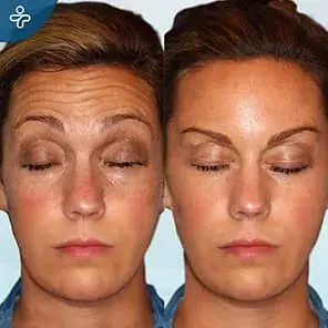 Complete Forehead Makeover