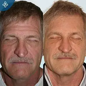 Male Forehead Lifting