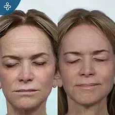 Forehead Surgery Before and After