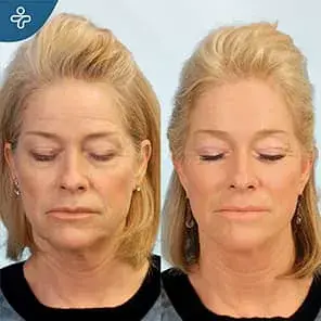Forehead Lifting Before and After Example