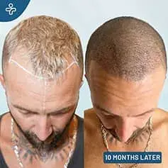 Unfiltered Before and After Results of our Patients FUE Hair Transplant Before & After