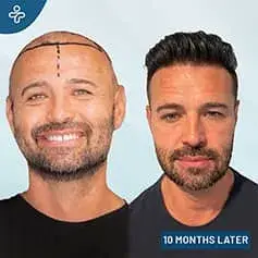+5000 Grafts Hair Transplant in Turkey Before and After