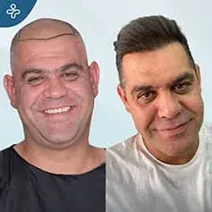 FUE Sapphire Before and After