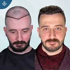 Hair Implant in Turkey Before and After