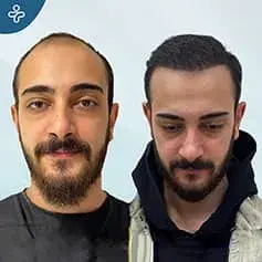 DHI Hair Transplant Before and After