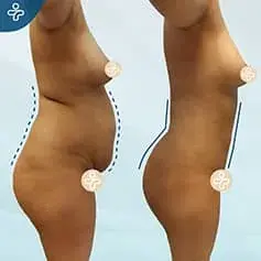 360 Lipo Before & After