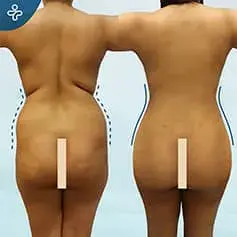 360 Lipo Before & After