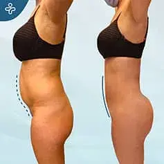 BBL and Liposuction Before/After