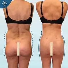 BBL and Liposuction Before/After