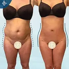 BBL and Liposuction Before/After