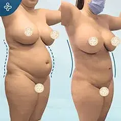 Mega Liposuction Before and After