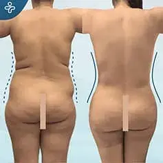 Mega Liposuction Before and After