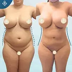 Mega Liposuction Before and After