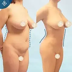 Hourglass Liposuction Before and After