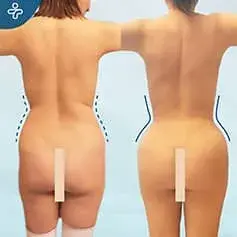 Hourglass Liposuction Before and After