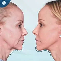 before-after-neck-lift-2