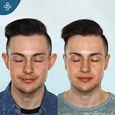 Ear Pinning Before and After Results