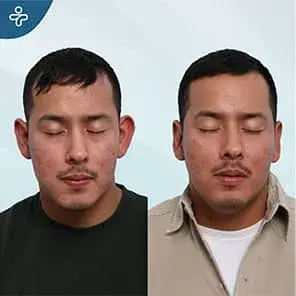 Ear Surgery Before and After