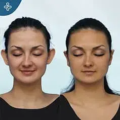 Otoplasty Before and After Unfiltered