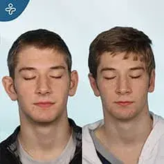 Male Otoplasty Before and After