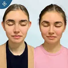 Female Otoplasty
