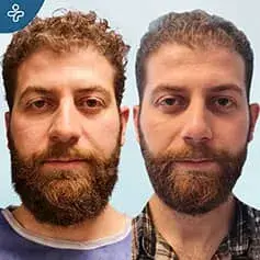 Roman Nose Rhinoplasty before and after