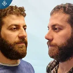 Roman Nose Rhinoplasty before and after