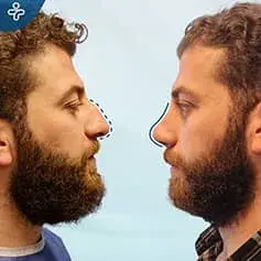 Roman Nose Rhinoplasty before and after