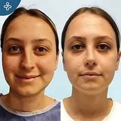Septoplasty in Turkey Before and After