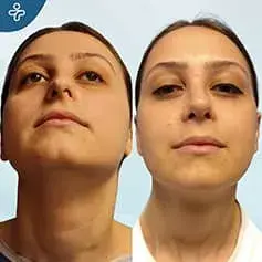 Septoplasty in Turkey Before and After