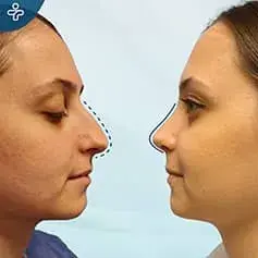 Septoplasty in Turkey Before and After