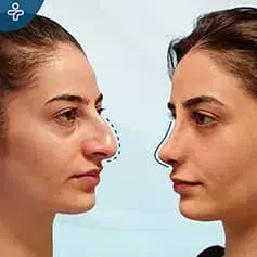 Aquiline Nose Nose job Before and After