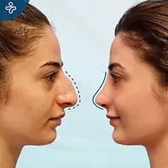 Aquiline Nose Nose job Before and After