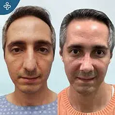 Bulbous Nose Rhinoplasty before and After
