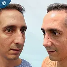 Bulbous Nose Rhinoplasty before and After