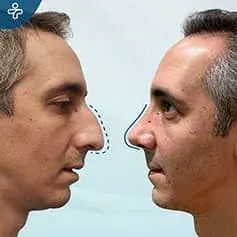 Bulbous Nose Rhinoplasty before and After