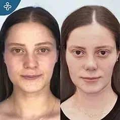 Septorhinoplasty Before and After