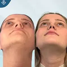 Septorhinoplasty Before and After