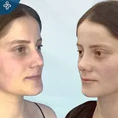 Septorhinoplasty Before and After
