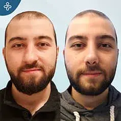 Male Rhinoplasty in Turkey Before and After