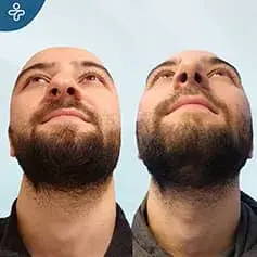 Male Rhinoplasty in Turkey Before and After