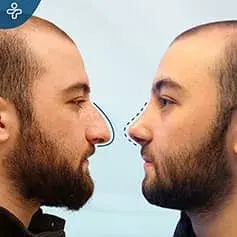Male Rhinoplasty in Turkey Before and After