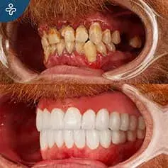 Full Hollywood Smile Before and After Makeover