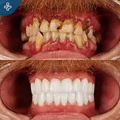 Full Hollywood Smile Before and After Makeover