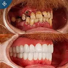 Full Hollywood Smile Before and After Makeover