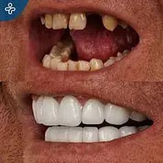 Single Tooth Implant and Crowns Before & After