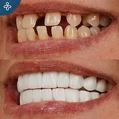 Full Mouth Dental Veneers in Turkey Before and After