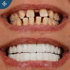Full Mouth Dental Veneers in Turkey Before and After